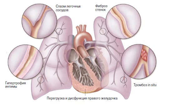 Диагностика и лечение легочной гипертензии2