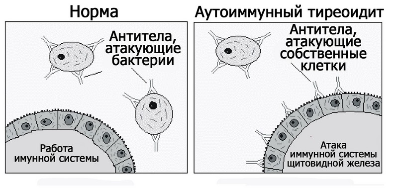 Аутоиммунный тиреоидит: симптомы, лечение2
