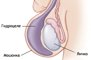 Водянка яичка у новорожденных и детей2