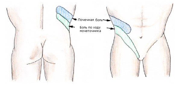 Почечная колика: симптомы, лечение2