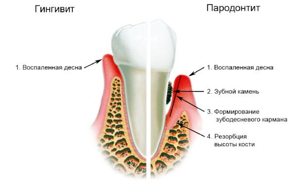 Гингивит: симптомы, лечение. Гингивит у беременных2