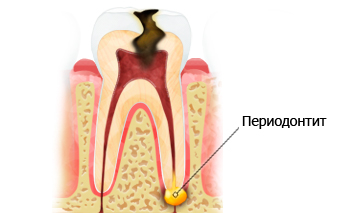 Периодонтит: симптомы, лечение2