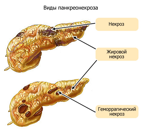 Панкреонекроз2