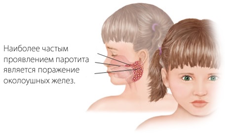 Паротит: у детей, у взрослых, симптомы, лечение, профилактика2