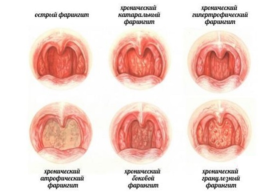 Лечение фарингита: народные средства или медикаментозное лечение2
