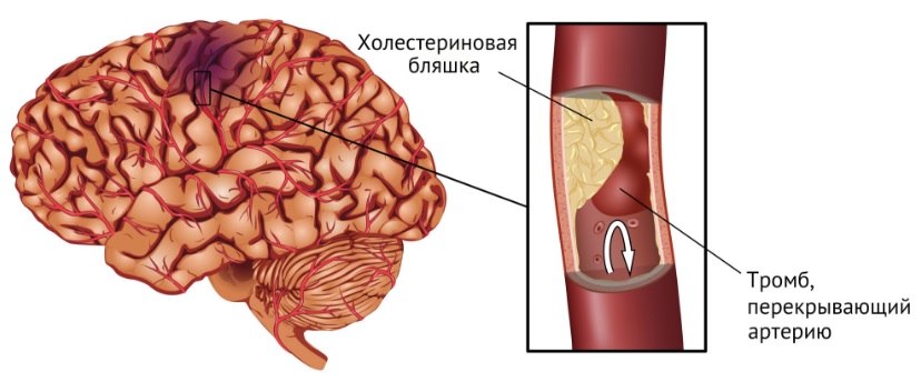 Инсульт у мужчин и женщин. Отличие, последствия.2