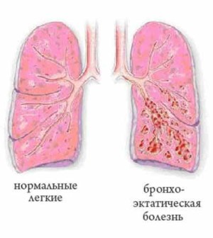 Реактивный менингит — что это такое?2