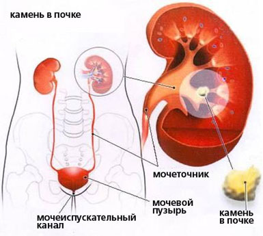 Половая жизнь при мочекаменной болезни. Лечение, последствия. 2