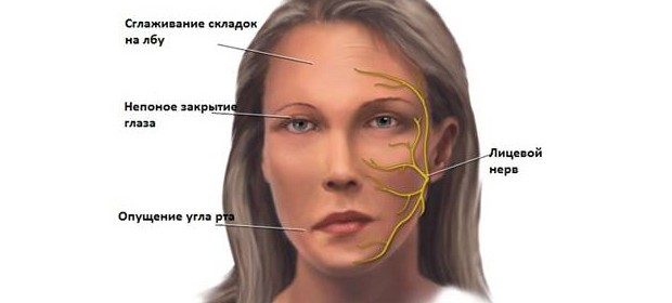 Невралгия тройничного нерва. Причины, последствия. 2