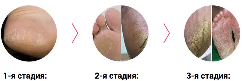 Грибок стопы у детей и взрослых2