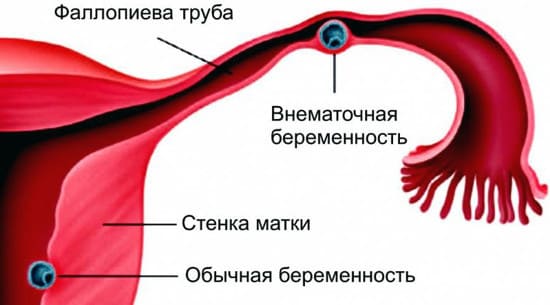 Признаки внематочной беременности3