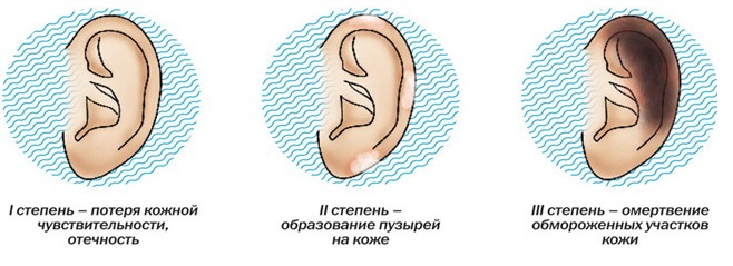 Первая помощь при обморожении2