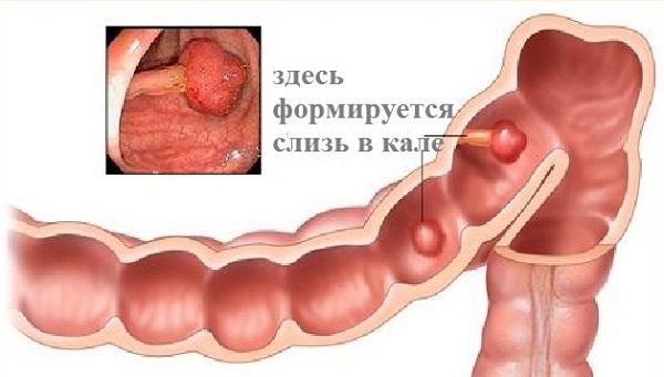 Слизь в стуле младенца2