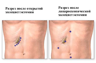 Лапароскопия желчного пузыря: показания, операция2