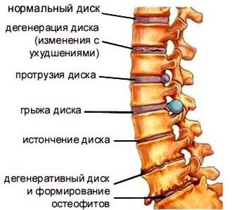 Протрузия позвоночника: причины, лечение, профилактика2