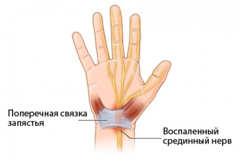 Синдром компьютерной мышки2