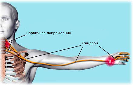 Синдром лестничной мышцы: симптомы, диагностика, лечение2