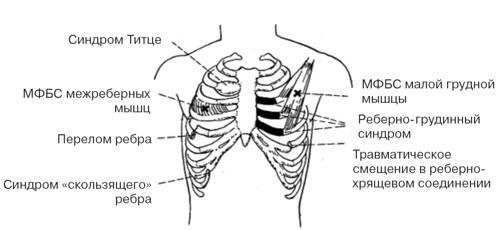 Синдром Титце: симптомы, диагностика, лечение2