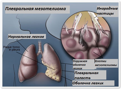 Мезотелиома плевры: симптомы, лечение, прогноз2