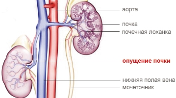 Нефроптоз почки2