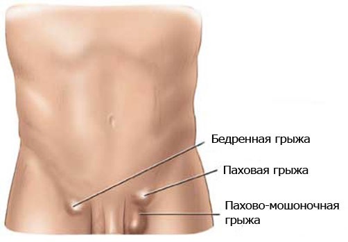 Бедренная грыжа: симптомы, лечение, операция, осложнения2