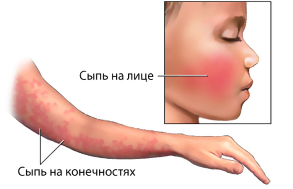 Фрамбезия: симптомы, причины, лечение2