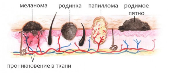 Меланома: симптомы, стадии, диагностика, прогноз2