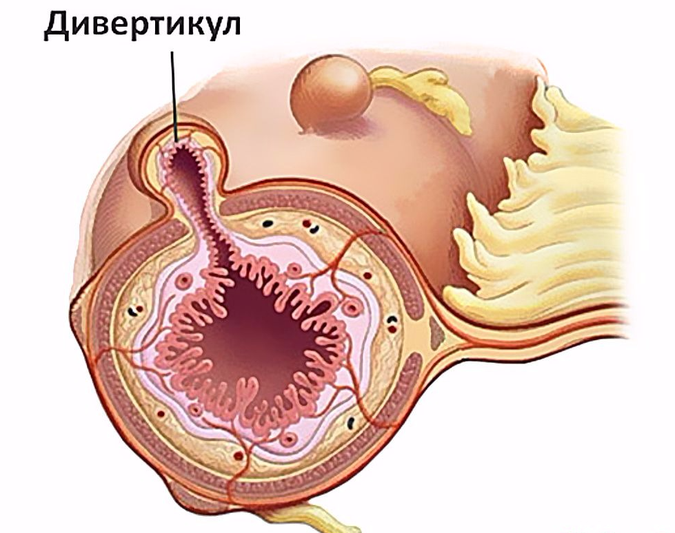 Дивертикул Меккеля: симптомы, причины, лечение2