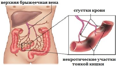 Нарушение кровообращения в кишечнике: симптомы, причины, лечение2