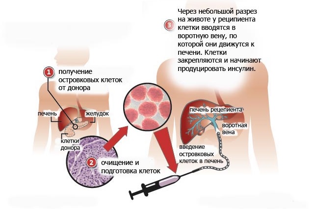 Трансплантация поджелудочной железы2