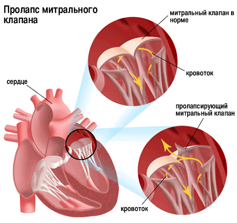 Аномалия Эбштейна2