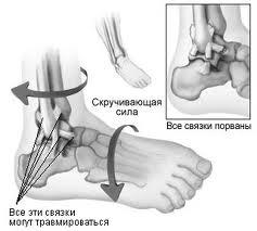 Лечение повреждений голеностопного сустава3