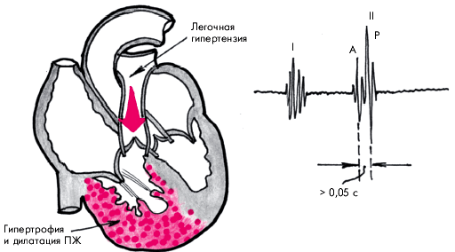 Морфология легочной гипертензии3