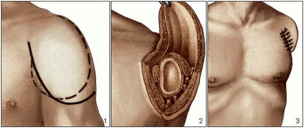Ампутация конечностей: история, особенности3