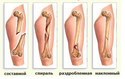 Лечение переломов у детей3