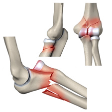 Травмы локтевой кости3