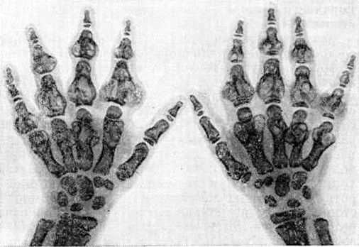 Дисхондроплазия3