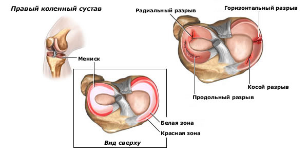 Повреждение мениска к3оленного сустава