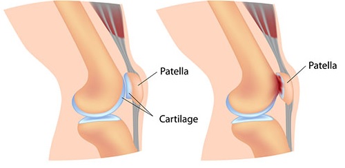 Хондромаляция надколенника3