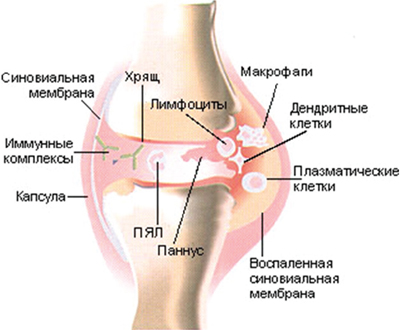 Поражение синовиальной оболочки3