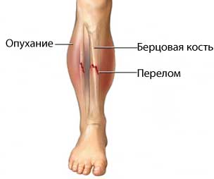 Перелом малоберцовой и большеберцовой кости3