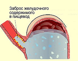 Лечение гастроэзофагеальной рефлюксной болезни3