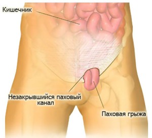 Эндоскопипческая операция по удалению грыжи3