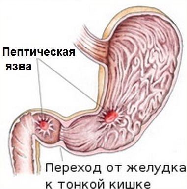 Торакоскопическая ваготомия3