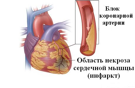 Почему болит в области сердца3