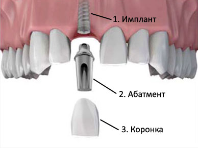 Естественный абатмент3