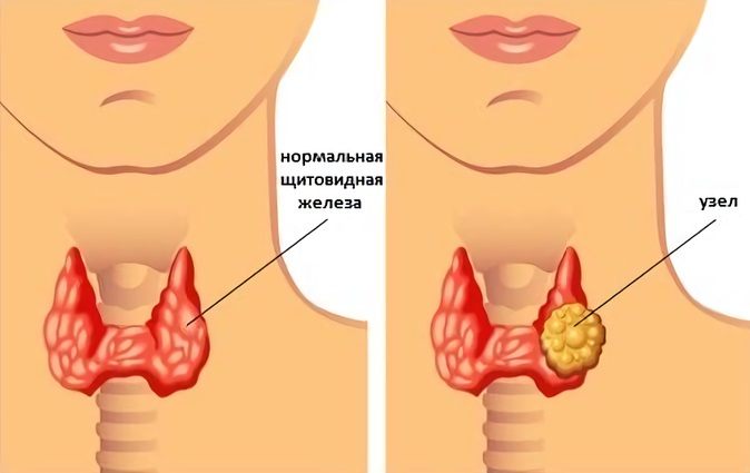 Диффузно-узловой зоб3