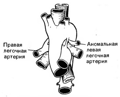 Аномалии дуги аорты3