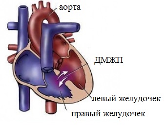 Клиника дефекта межжелудочковой перегородки3