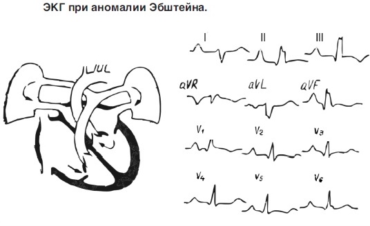Лечение аномалии Эбштейна3